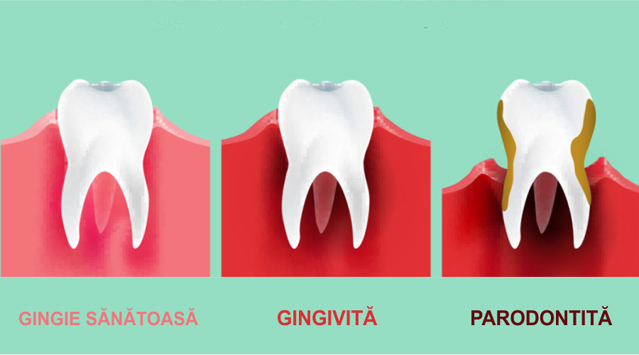 Diferența dintre gingivită și parodontoză
